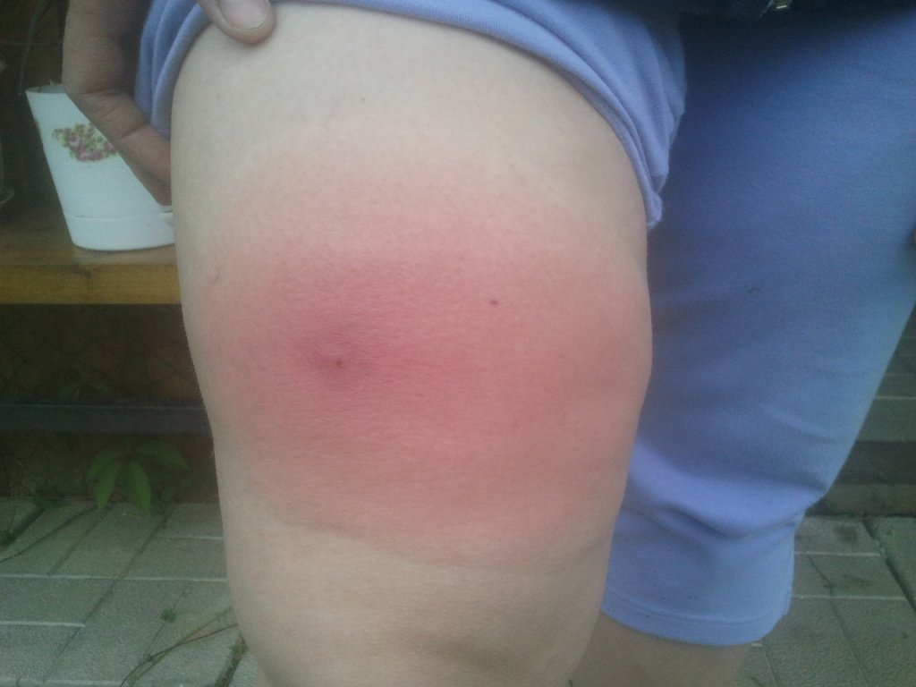 Укус мошки, фото і як зняти набряк