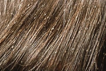 Ефективність перекису водню від вошей