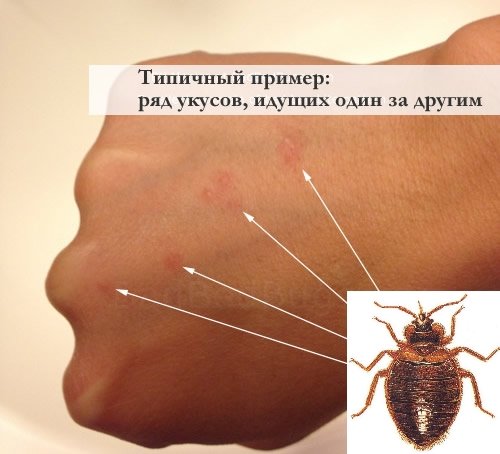 Симптоми і лікування алергії на укуси клопів