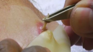 Людський овод: паразитування на людині, дерматобиаз, профілактика