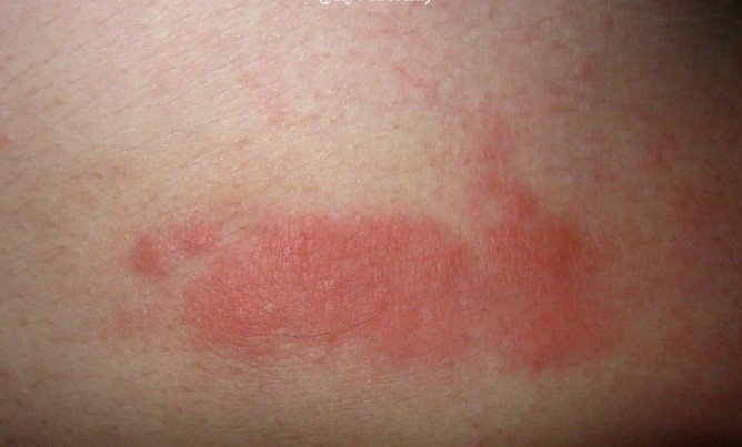 Які хвороби переносять клопи і чим вони небезпечні для людини