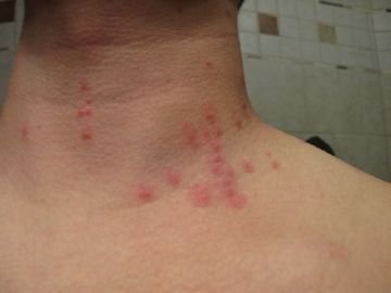 Як виглядає людська блоха і як від неї позбутися