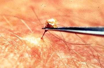 Укус бджоли: корисно чи небезпечно? Як швидко і ефективно вилікувати бджолиний укус?