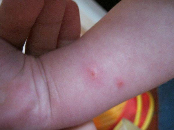 Укус комара: фото, зображення, картинки