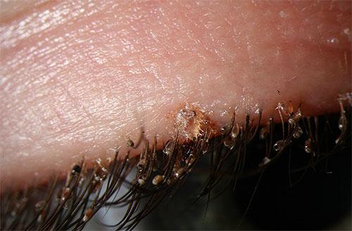 Як розмножуються воші   особливості статевого та життєвого циклу