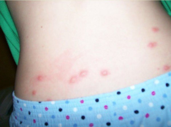 Укус постільного клопа у людей: фото, картинки