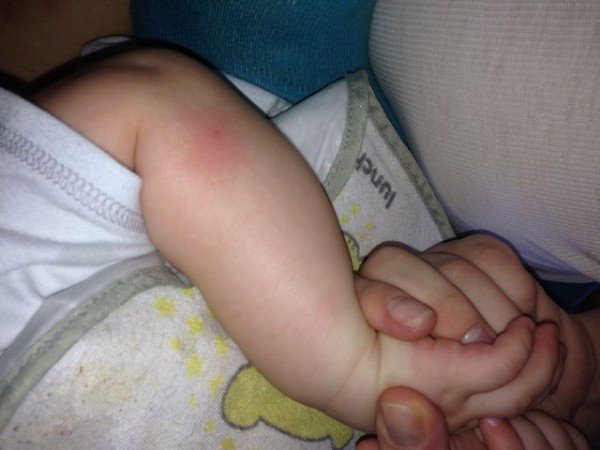 Укуси клопів   лікування, наслідки. Методи боротьби з клопами