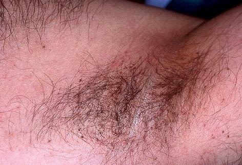 Чим харчуються воші – спосіб життя і особливості