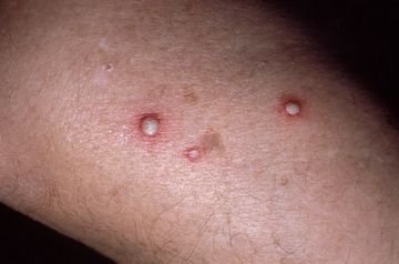 Мураха лісової: користь чи шкода