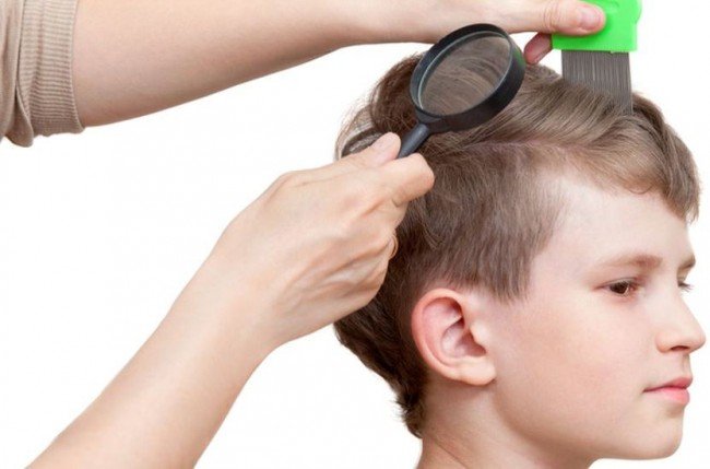 Від чого зявляються воші: Лікування і як обрати вірну стратегію