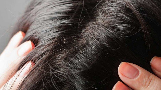 Воші: що робити, якщо заразилася дитина — як перемогти заразу? Воші: що робити, якщо заразилася дитина — як перемогти заразу?