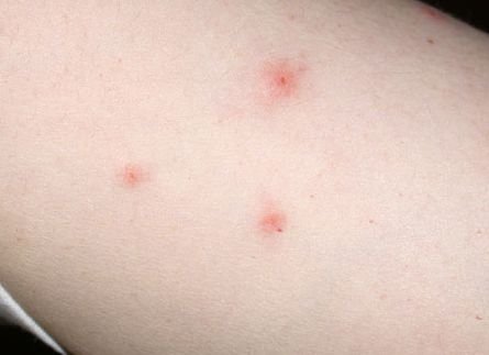 Хто такі постільні кліщі і як від них позбавитися