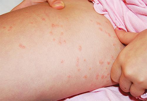 Воші – симптоми появи і фото укусів