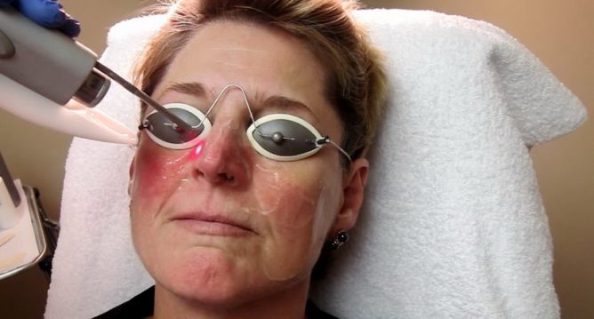 Лікування демодекозу на обличчі: як позбутися від особового кліща