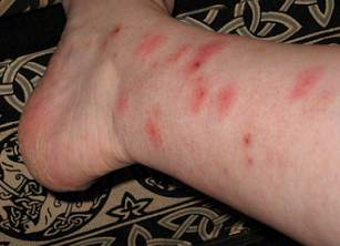 Клопи   як виявити їх гніздо в міській квартирі