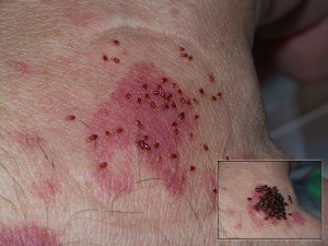 Як виглядають укуси клопів: симптоми і наслідки