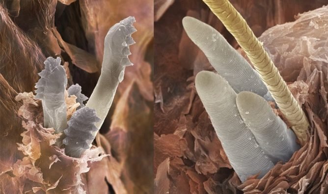 Підшкірний кліщ у людини лікування сучасне і народне Підшкірний кліщ у людини лікування сучасне і народне