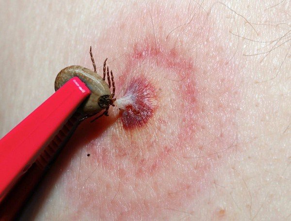 Укуси кліщів у людей і собак: фотографії, зображення