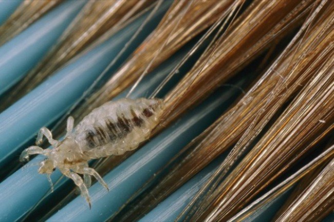 Як позбавитися від вошей: домашні та лікарські засоби