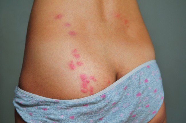 Укуси постільних клопів — Як виглядають і чим лікувати (фото)