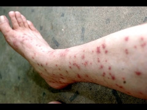 Постільні клопи в квартирі
