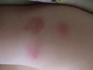 Пацюча блоха: опис, розмноження, заходи боротьби, допомога при укусах Пацюча блоха: опис, розмноження, заходи боротьби, допомога при укусах