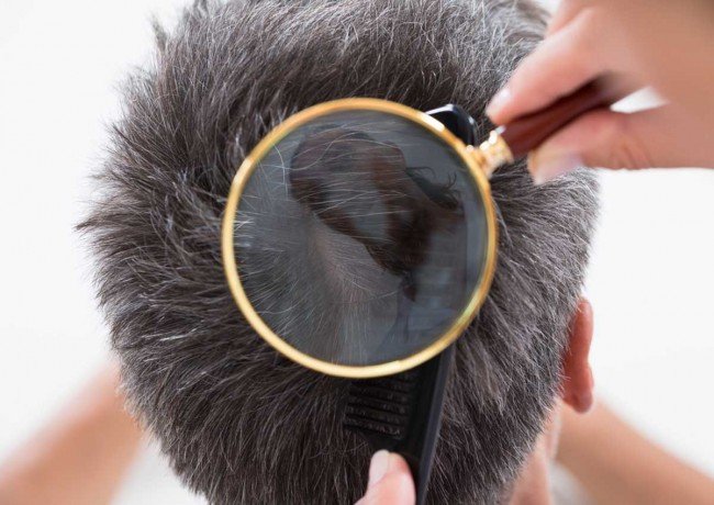 Домашні воші: як швидко і ефективно від них позбутися?