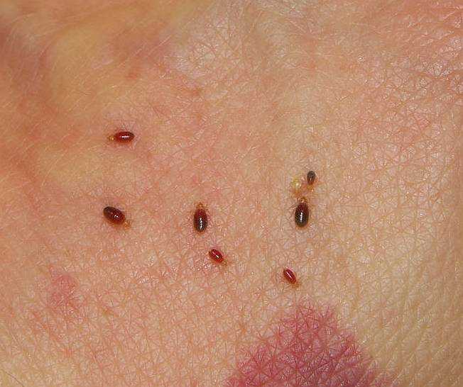 Укуси постільних клопів: симптоми, лікування, фото