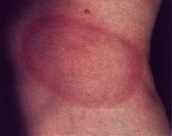 Укуси кліщів у людей і собак: фотографії, зображення