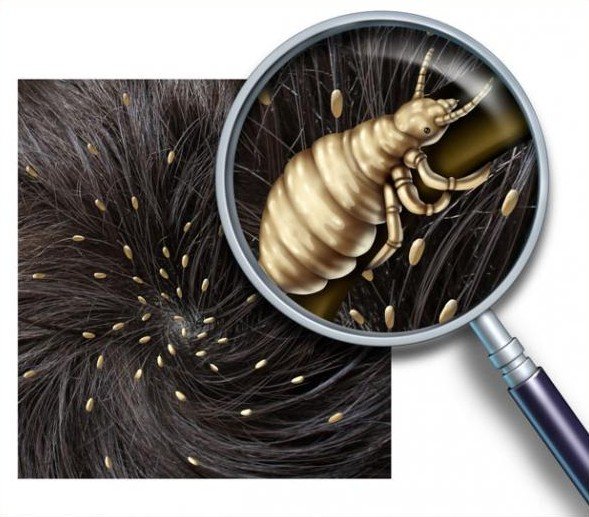 Як зявляється вша: перші ознаки педикульозу