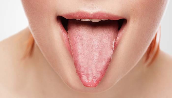 Білий наліт на язиці у дорослих: у чому причини і яке лікування необхідно + фото