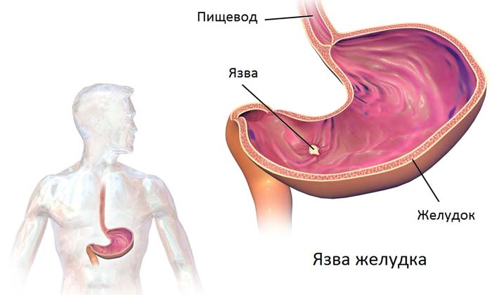 Де знаходиться шлунок у людини (фото) і які симптоми при виразці шлунку