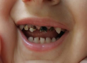 Сонник Випав Передній Зуб: верхній або нижній уві сні бачити до чого сниться? Сонник Випав Передній Зуб: верхній або нижній уві сні бачити до чого сниться?