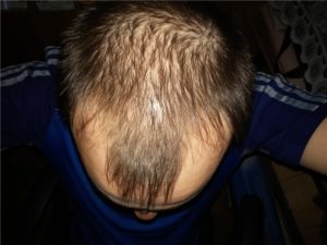 Сонник Облисіння своєї голови: частково, для дівчини жінки уві сні бачити до чого сниться?
