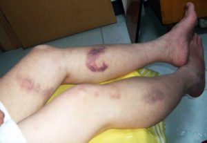 Сонник Шишка на Голові, Лобі, ноги у сні бачити до чого сниться?