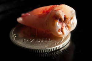 Сонник Випав Передній Зуб: верхній або нижній уві сні бачити до чого сниться? Сонник Випав Передній Зуб: верхній або нижній уві сні бачити до чого сниться?