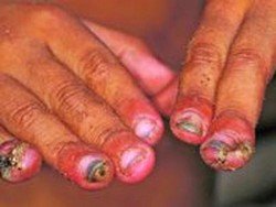 Піщані блохи з за кордону   фото і як позбутися