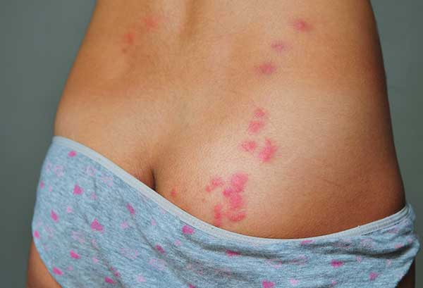 Меблеві клопи (фото) як позбутися і вивести самостійно