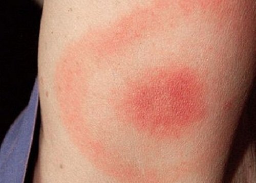 Людська блоха: фото, поширювані захворювання і як позбутися