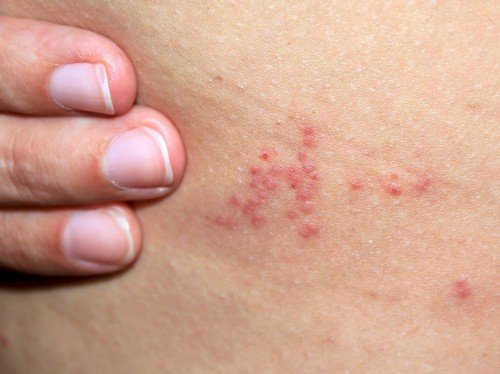 Постільні клопи фото: як позбутися в домашніх умовах Постільні клопи фото: як позбутися в домашніх умовах