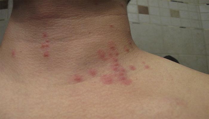 Котячі блохи кусають людей: чи це так, як позбутися від паразитів