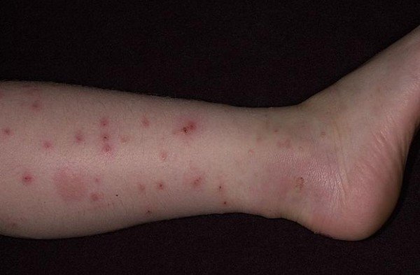 Підвальні блохи: небезпека і боротьба