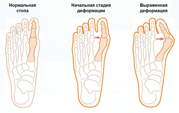 шишки на ногах біля великого пальця: лікування народними засобами + дієта