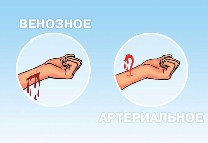 Кровотеча з вени і артерії: як можна зупинити в домашніх умовах