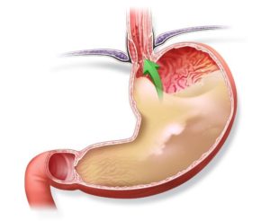 Чи можна вживати сметану при гастриті