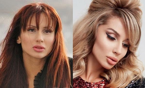 Світлана Лобода до та після пластики