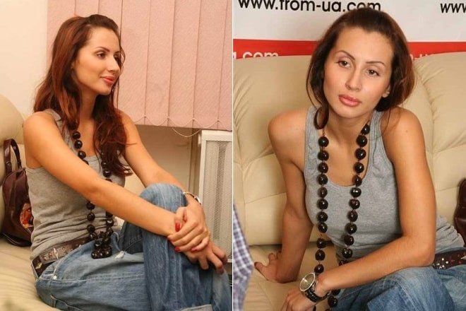 Світлана Лобода до та після пластики