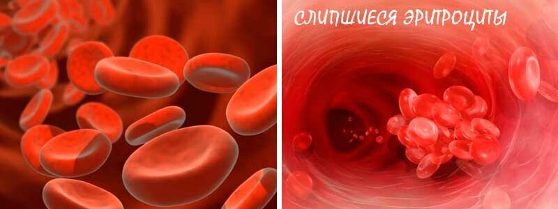 Що робити в домашніх умовах при високому тиску — харчування, вправи та масаж