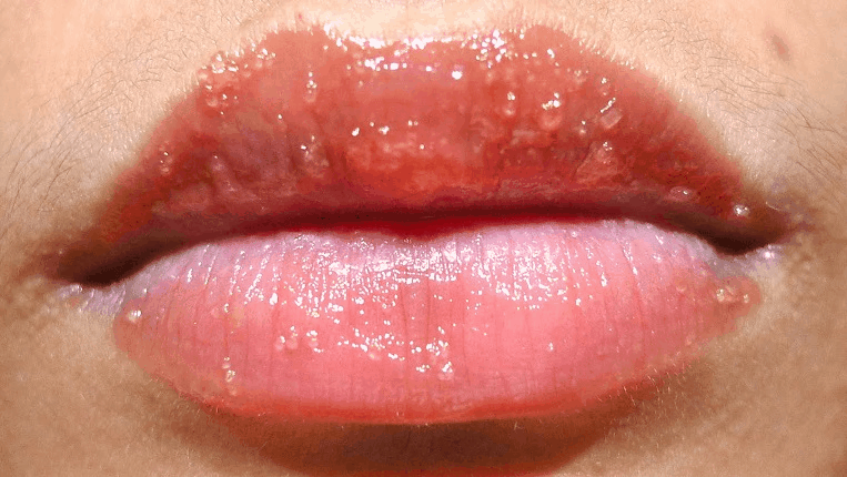 Як розшифрувати сон про застуді на губі — 42 докладних значення