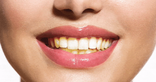 Що означає сон про білі зуби у себе або іншої людини — 24 тлумачення